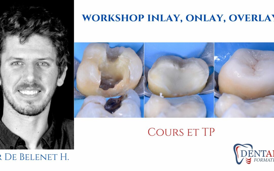 Workshop Inlay, Onlay, Overlay et V-preps