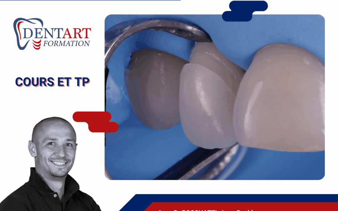 Workshop Facettes Live J1 : preparation provisoire empreinte