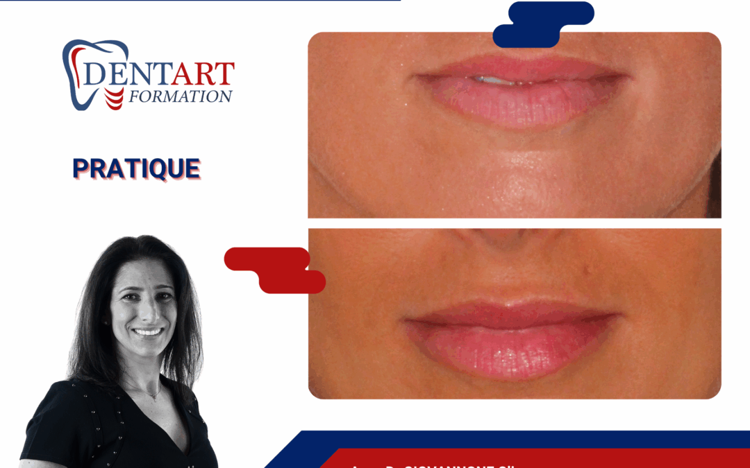 Injection d&rsquo;acide hyaluronique par les chirurgiens-dentistes – Pratique