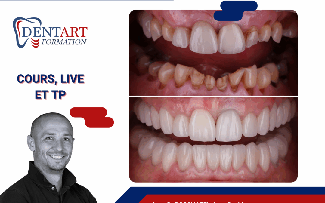 Esthétique 2.0 : focus usures sévères